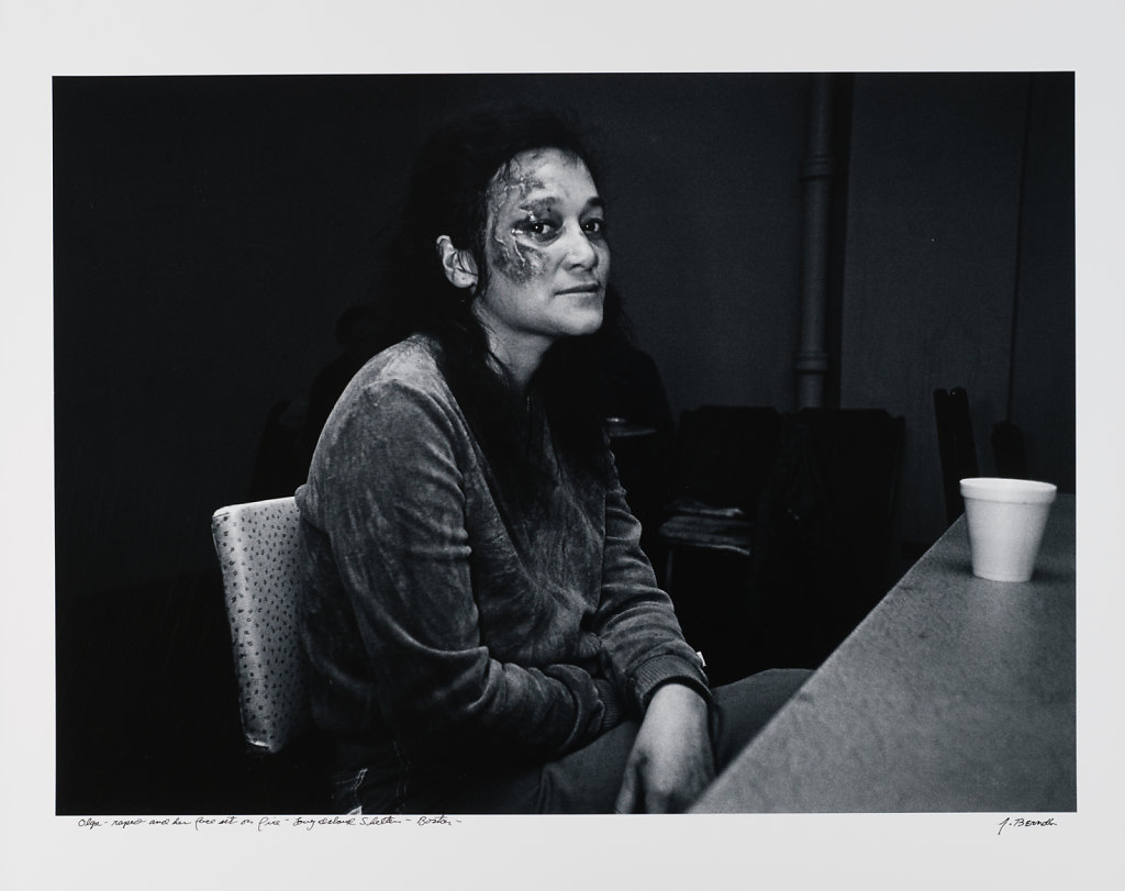 Olga, raped and her face set on fire, Long Island Shelter, Boston, 1983
